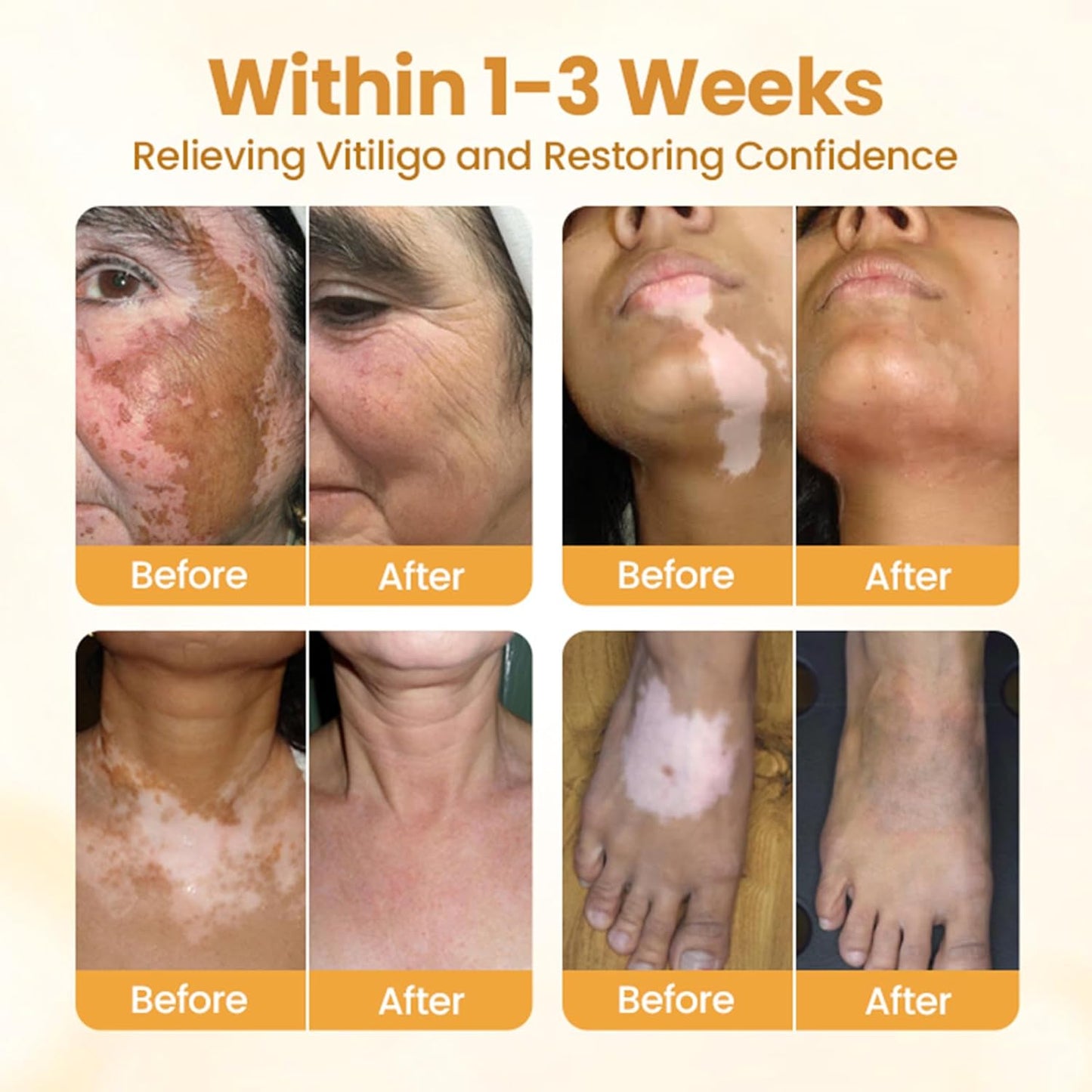 VITIGO BEE VENOM CREAM