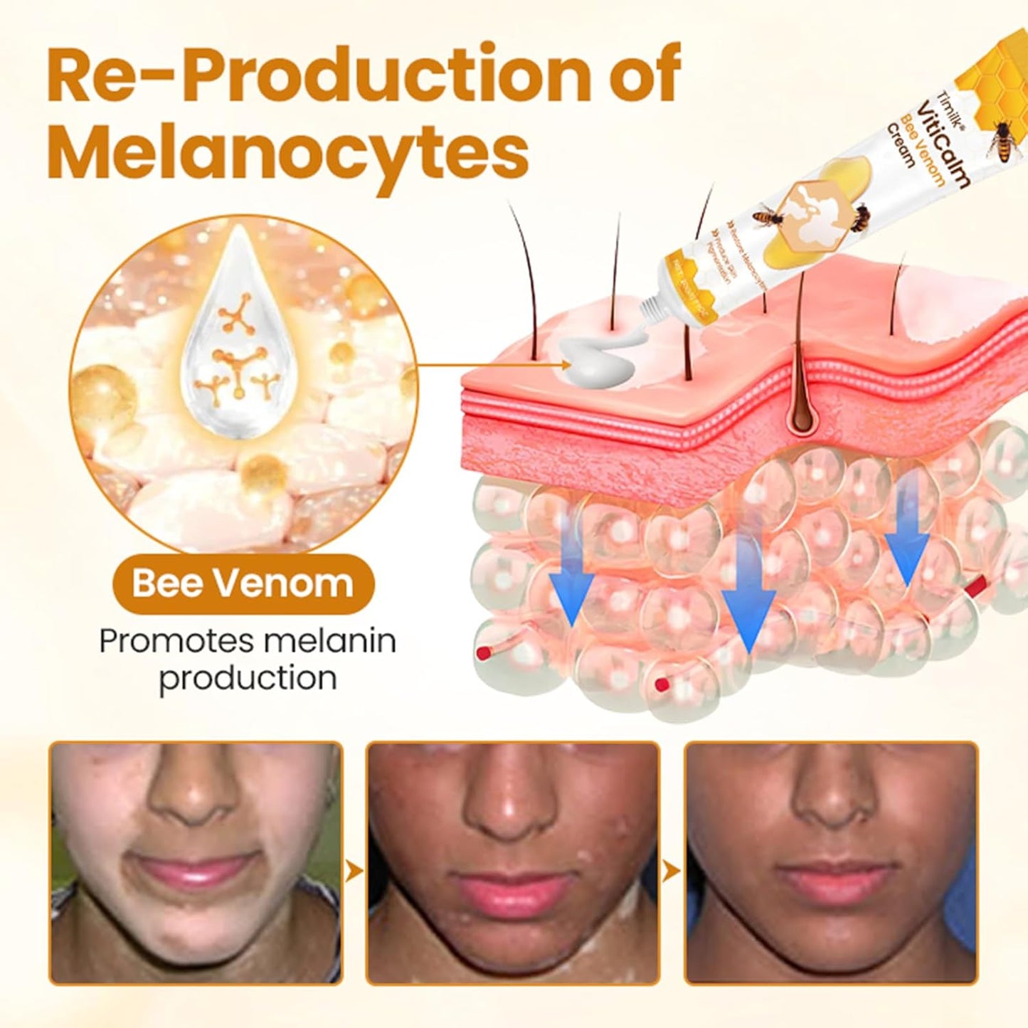 VITIGO BEE VENOM CREAM