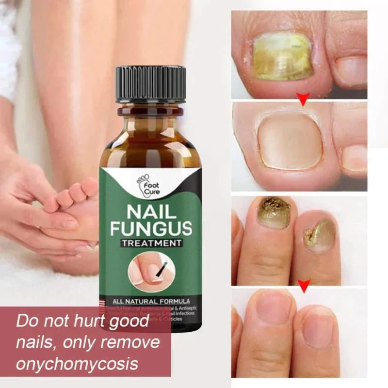 NAIL FUNGUS SERUM