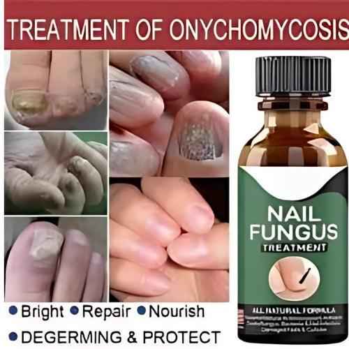NAIL FUNGUS SERUM