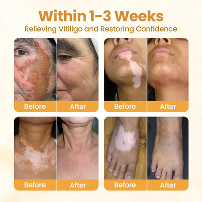 VITIGO BEE VENOM CREAM